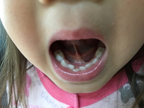 子供の歯並びがガタガタなので歯科医へ相談してみた